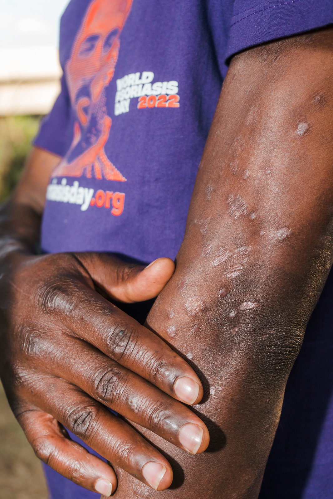 Understanding psoriasis through patient education and care